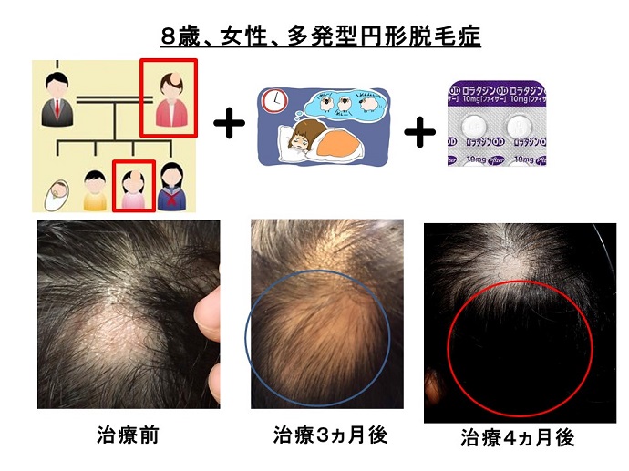 円形脱毛症　病院